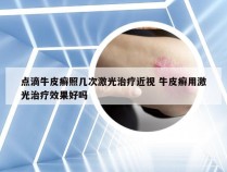 点滴牛皮癣照几次激光治疗近视 牛皮癣用激光治疗效果好吗