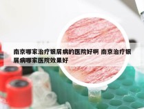 南京哪家治疗银屑病的医院好啊 南京治疗银屑病哪家医院效果好