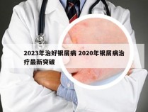 2023年治好银屑病 2020年银屑病治疗最新突破