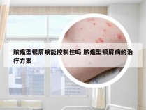 脓疱型银屑病能控制住吗 脓疱型银屑病的治疗方案