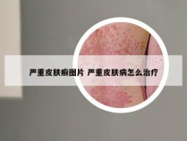 严重皮肤癣图片 严重皮肤病怎么治疗