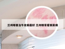 兰州哪里治牛皮癣最好 兰州哪家看银屑病