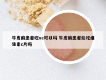牛皮癣患者吃vc可以吗 牛皮癣患者能吃维生素c片吗