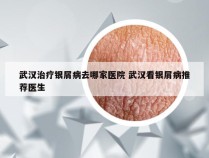 武汉治疗银屑病去哪家医院 武汉看银屑病推荐医生