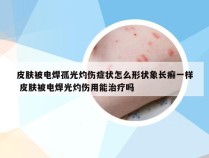 皮肤被电焊孤光灼伤症状怎么形状象长癣一样 皮肤被电焊光灼伤用能治疗吗
