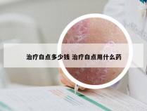 治疗白点多少钱 治疗白点用什么药