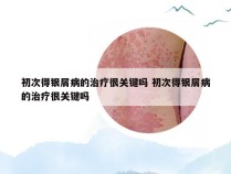 初次得银屑病的治疗很关键吗 初次得银屑病的治疗很关键吗
