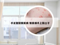 手足皲裂银屑病 银屑病手上裂口子