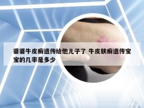 婆婆牛皮癣遗传给他儿子了 牛皮肤癣遗传宝宝的几率是多少