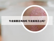 牛皮癣要忌鸡肉吗 牛皮癣用忌口吗?