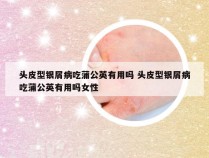 头皮型银屑病吃蒲公英有用吗 头皮型银屑病吃蒲公英有用吗女性