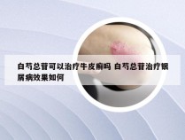 白芍总苷可以治疗牛皮癣吗 白芍总苷治疗银屑病效果如何