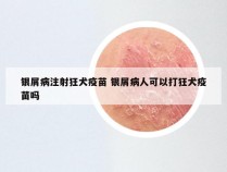银屑病注射狂犬疫苗 银屑病人可以打狂犬疫苗吗