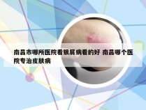 南昌市哪所医院看银屑病看的好 南昌哪个医院专治皮肤病