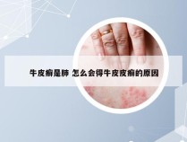 牛皮癣是肺 怎么会得牛皮皮癣的原因