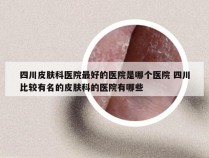 四川皮肤科医院最好的医院是哪个医院 四川比较有名的皮肤科的医院有哪些