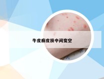 牛皮癣皮损中间变空