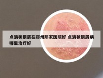 点滴状银屑在郑州那家医院好 点滴状银屑病哪里治疗好