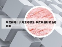 牛皮癣用什么方法可根治 牛皮癣最好的治疗方案