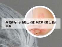 牛皮癣为什么会脸上长痘 牛皮癣长脸上怎么回事