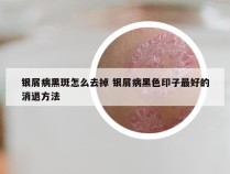 银屑病黑斑怎么去掉 银屑病黑色印子最好的消退方法