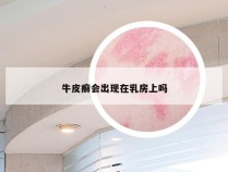 牛皮癣会出现在乳房上吗