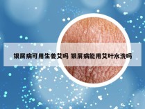 银屑病可用生姜艾吗 银屑病能用艾叶水洗吗