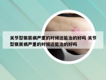 关节型银屑病严重的时候还能治的好吗 关节型银屑病严重的时候还能治的好吗