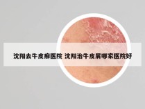 沈阳去牛皮癣医院 沈阳治牛皮屑哪家医院好
