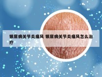 银屑病关节炎痛风 银屑病关节炎痛风怎么治疗