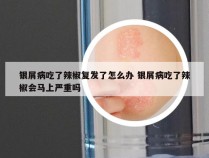 银屑病吃了辣椒复发了怎么办 银屑病吃了辣椒会马上严重吗