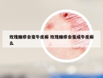 玫瑰糠疹会变牛皮癣 玫瑰糠疹会变成牛皮癣么