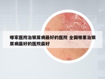 哪家医院治银屑病最好的医院 全国哪里治银屑病最好的医院最好