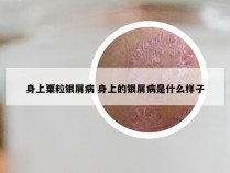 身上粟粒银屑病 身上的银屑病是什么样子