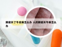 脚底长了牛皮癣怎么办 人的脚底长牛癣怎么办