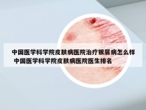 中国医学科学院皮肤病医院治疗银屑病怎么样 中国医学科学院皮肤病医院医生排名