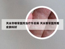 天水市哪家医院治疗牛皮癣 天水那家医院看皮肤科好