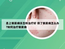 患上银屑病该怎样治疗好 得了银屑病怎么办?如何治疗银屑病