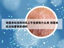 地塞米松洗剂对头上牛皮癣有什么用 地塞米松会加重银屑病吗
