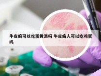 牛皮癣可以吃蛋黄派吗 牛皮癣人可以吃鸡蛋吗