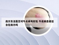 南方生活是否对牛皮癣有好处 牛皮癣患者适合在南方吗