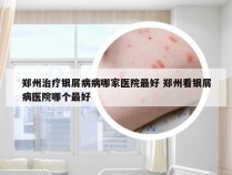 郑州治疗银屑病病哪家医院最好 郑州看银屑病医院哪个最好