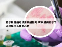 怀孕银屑病可以用白醋擦吗 有银屑病怀孕了可以摸什么样的药物