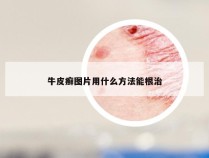 牛皮癣图片用什么方法能根治