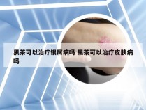 黑茶可以治疗银屑病吗 黑茶可以治疗皮肤病吗