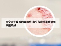南宁治牛皮癣的好医院 南宁市治疗皮肤病哪家医院好
