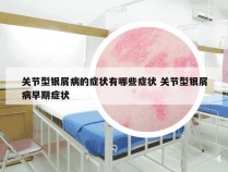 关节型银屑病的症状有哪些症状 关节型银屑病早期症状