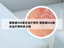 银屑病308激光治疗贵吗 银屑病308激光治疗贵吗多少钱