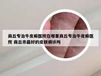 商丘专治牛皮癣医院在哪里商丘专治牛皮癣医院 商丘市最好的皮肤病诊所