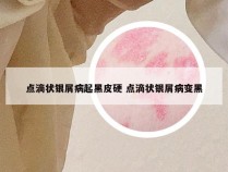 点滴状银屑病起黑皮硬 点滴状银屑病变黑